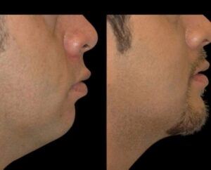 Double Chin Removal for a Youthful Appearance: Insights from the Best Doctors in Dubai