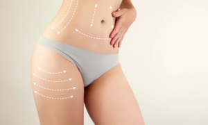 Definitive Guide to Liposuction Discover Best Doctors in Dubai