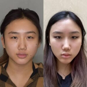 How Buccal Fat Removal Affects Self-Confidence: Best Doctors in Dubai Discuss