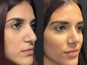 How to Find the Best Doctor for Nose Deviated Septum Surgery in Dubai