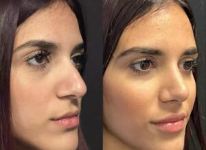 Septoplasty in Dubai: Can It Fix Snoring and Improve Sleep Quality?