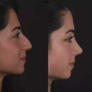 From Diagnosis to Recovery: Best Septoplasty Surgeons in Dubai Guide You