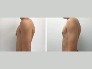 Best Gynecomastia Surgeons in dubai: How to Minimize Scarring After Surgery