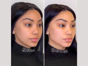 Best Aesthetic Clinic in Dubai: Combining Thread Lift with Other Aesthetic Treatments for