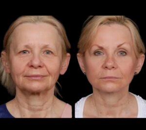 Top Benefits of Under Eye Fillers at the Best Aesthetic Clinic in Dubai