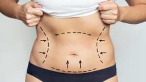 A Deep Dive into Full Body Liposuction in Dubai Results and Recovery Explained