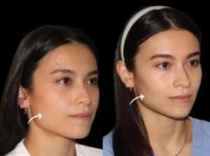 How Sculptra Fillers Treatment in Dubai Enhances Natural Beauty Over Time