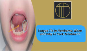 Tongue Tie in Newborns: When and Why to Seek Treatment