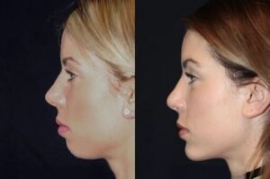 Perfect Chin Contours with the Best Plastic Surgeons in dubai