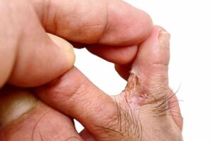 Sweat & Foot Eczema: How Moisture Aggravates the Condition