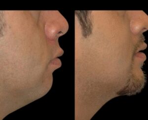 How to Maintain Results After Double Chin Removal with the Best Doctors in Dubai