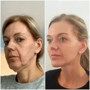 How Dubai’s Top Surgeons Are Using Technology to Improve Breast Augmentation Results