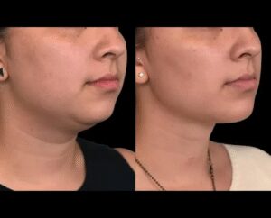 Best Double chin removal Surgeon in dubai: Your Complete Guide to Non-Surgical Treatments
