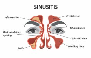 How a Sinus Infection Affects Your Hearing and Balance