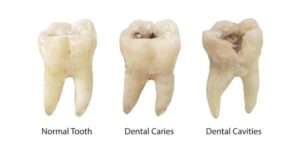 Dental Crowns: The Ultimate Solution for Restoring Your Smile