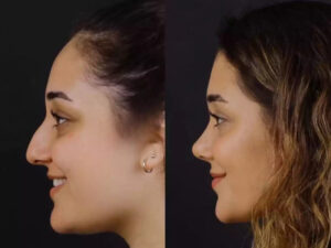 Can the Best Septoplasty Surgeon in Dubai Also Do Rhinoplasty?