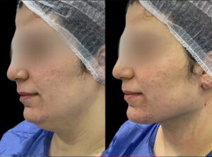 Best Plastic Surgeons in dubai for Chin Fillers Enhance Your Facial Harmony