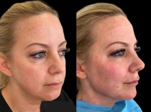 Cheek Fillers: Why the Best Plastic Surgeon in Dubai Should Be Your First Choice