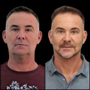 Refuel Radiance through Profhilo Treatments in Dubai