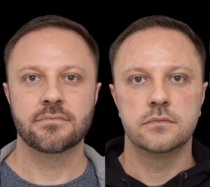 The Best Plastic Surgeons in Dubai Are Trusted for Under Eye Fillers