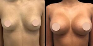 How the Best Breast Augmentation Surgeons in Dubai Achieve the Perfect Balance Between Size and Shape