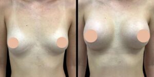 Best Breast Augmentation Surgeons in Dubai for Expats and Locals