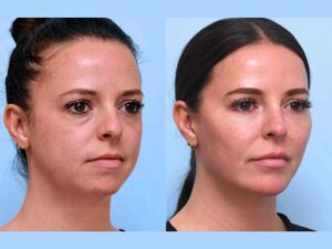 Best Plastic Surgeons in Dubai Everything You Need to Know About Thread Lifts