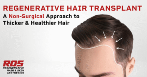 Is Stem Cell Therapy the Future of Hair Transplantation?