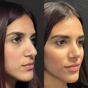 Before and After: Real Results from Nose Surgery in Dubai