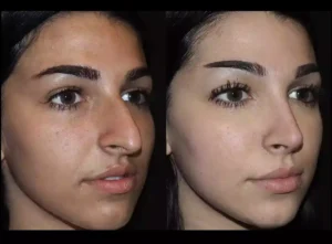 rhinoplasty in dubai