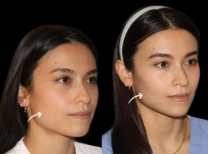 Anti-Aging Innovation: Sculptra Fillers Recommended by Best Doctors in Dubai