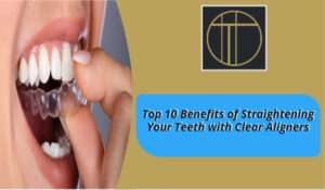 Top 10 Benefits of Straightening Your Teeth with Clear Aligners