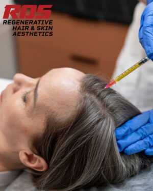 Step-by-Step Guide to Stem Cell Hair Therapy in Hyderabad