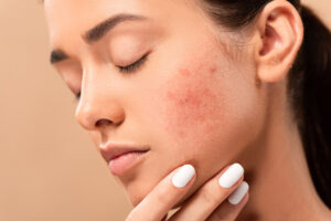 Affordable Acne Removal Services in Ilford: What Are Your Options?