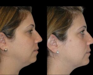 Recovery Tips After Double chin removal by Best Double chin removal Surgeons in dubai