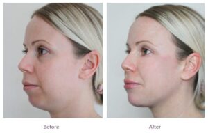How the Best Plastic Surgeons in dubai Enhance Facial Structure with Jawline Fillers