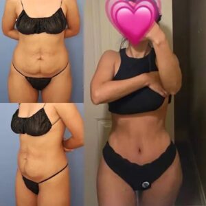 Best Doctors in Dubai: How to Maintain Tummy Tuck Results Long-Term