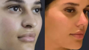 Best Doctors in Dubai for Rhinoplasty: Sculpting Your Dream Nose