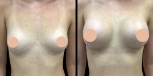Breast Augmentation in Dubai: What Are the Latest Trends and Techniques in Breast Surgery