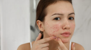 How Often Should I Get Acne Treatments In Dubai?