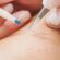 Electrolysis Laser Hair Removal in Dubai