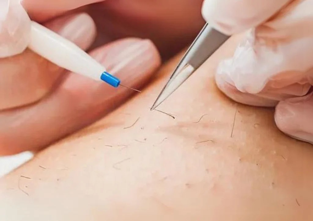 Electrolysis Laser Hair Removal in Dubai