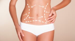 Liposuction