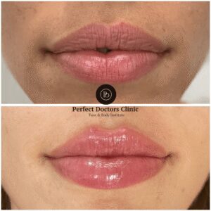 How Juvederm Works for Facial Contouring: Best Plastic Surgeons in dubai Share Their Techniques