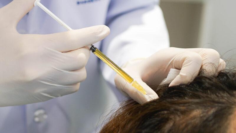 Best PRP Hair Treatment in Dubai
