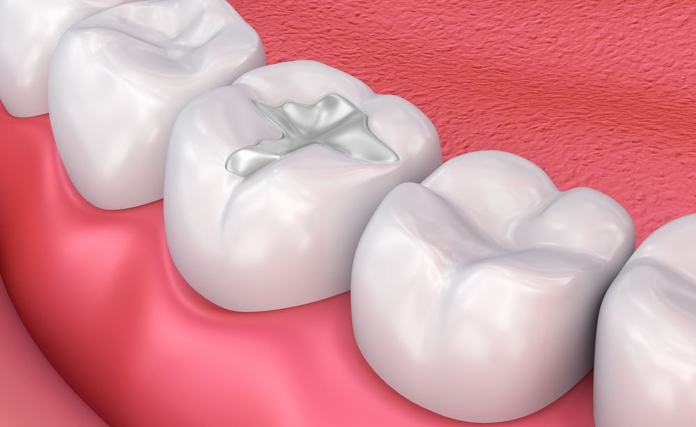 Tooth Filling Cost in Dubai