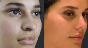 rhinoplasty in dubai