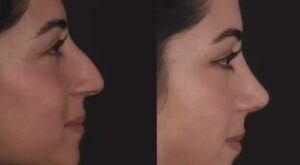 septoplasty in dubai