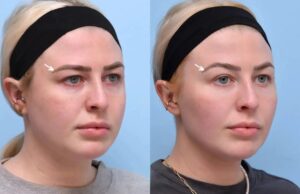 How Botox at the Best Aesthetic Clinics in Dubai Can Help Reduce Fine Lines and Wrinkles