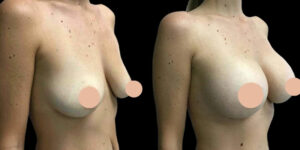 Is Breast Augmentation in Dubai Affordable?